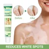 Sumifun Vitiligo Cream Reduces White Spots and Improves Skin Pigmentation 20gram
