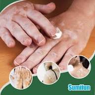 Sumifun Vitiligo Cream Reduces White Spots and Improves Skin Pigmentation 20gram